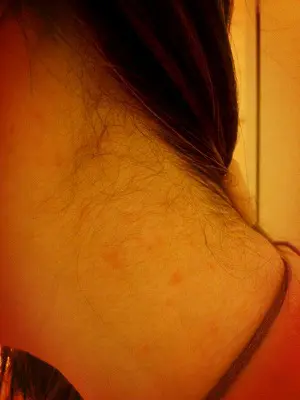 刺されたところ